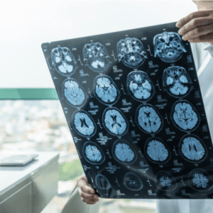 doctor seeing a brain injury through a magnetic mesonance imaging