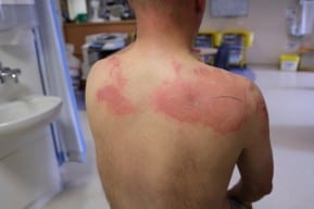 A serious burn injury on the back of a New Jersey burn injury lawyer